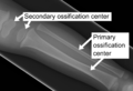 X-ray of ossification centers Attribution-Share Alike 3.0 Unported license, attributed to James Heilman and Mikael Häggström