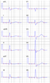 Electrocardiography with digoxin