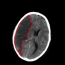 CT-beeld van een herseninfarct rechts (links op de afbeelding). Het donkere gebied is oedeem, met daarin (niet te onderscheiden) necrotisch weefsel.