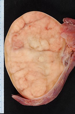 Description de l'image Seminoma of the Testis.jpg.