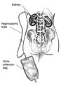 Nefrostoma