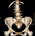 腰椎の先天的塊状椎。CTボリュームレンダリング。