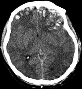 CT-scan waarop een hersenkneuzing, hersenbloeding, subduraal hematoom en schedelfracturen te zien zijn.[1]