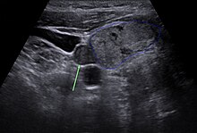 Nebenschilddrüse in der Sonographie