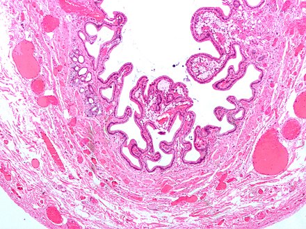 Micrograph of cholesterolosis of the gallbladder