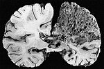 Thumbnail for Cerebral arteriovenous malformation