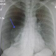 Chest X-ray showing a pneumothorax on the right (left in the image), where the absence of lung markings indicates that there is free air inside the chest