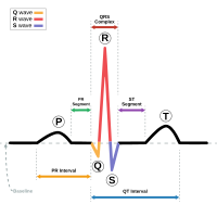 Skematiese diagram van normale sinusritme vir 'n mens se hart soos gesien op 'n EKG.