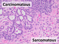 Carcinosarcoma, having mixed carcinomatous and sarcomatous elements