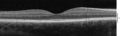 Spectral-Domain OCT macula cross-section scan.