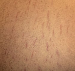 Belly Strech Marks.jpg