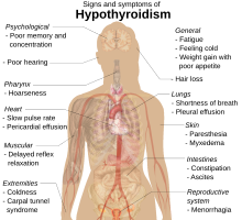 Hypothyroidism.svg