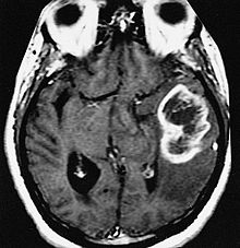 AFIP-00405558-Glioblastoma-Radiology.jpg