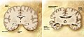 Un comparison de cerebro normal (leve) et de persona cum Alzheimer (directe). Characteristicas que differa se indicate.