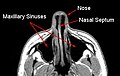 MRI ile görüntülenen burun bölmesi (nasal septum)