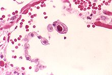 Typical "owl eye" intranuclear inclusion indicating CMV infection of a lung pneumocyte