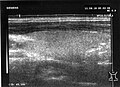 Fig. 2 Ultrasonic: Cross section of the right lobe