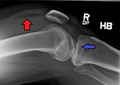 Lipohemarthrosis due to a tibial plateau fracture