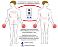 Commonly involved sites of rashes of scabies[7]