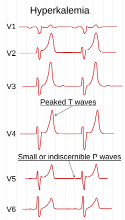 ECG in hyperkalemia.svg