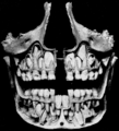 Dentes decíduos, erupção dos permanentes.