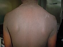 Description de l'image Familial acanthosis nigricans2.jpg.