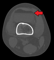 Lipohemarthrosis due to a tibial plateau fracture