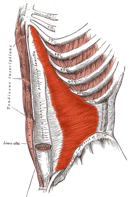 Anatomische schets van buikspieren. Rood de m. transversus abdominis, wit verticaal de schede van de m. rectus abdominis