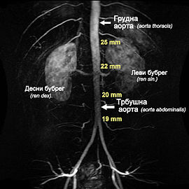 MRT snimak trbušne aorte i njenih bočnih grana