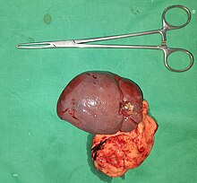 Splenectomy specimen.jpg