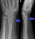 Thumbnail for Distal radius fracture