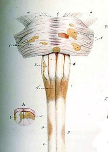 Carswell-Multiple Sclerosis2.jpg