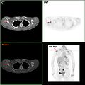 F-18 FDG PET/CT: A breast cancer metastasis to the right scapula