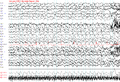 Generalisierter Spike-Wave-Komplex über 20 Sekunden