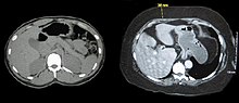 Two computed tomography images of a horizontal section of the mid abdominal region; one from a normal weight individual the other from an obese person. In both the bony structures and organs appear similar. The primary difference is that in the normal weight person there is little subcutaneous fat and the obese person shows substantially subcutaneous fat.