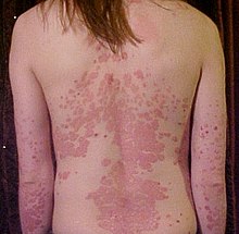 Psoriasis on back1.jpg