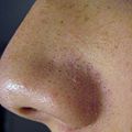 Blackheads, sebum darkened by contact and reaction with air.