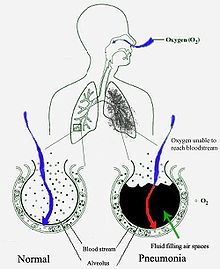 Diagram skematik paru-paru manusia dengan lingkaran kosong di sisi kiri mewakili alveolus normal dan di sisi kanan menunjukkan alveolus yang terisi penuh cairan seperti dijumpai pada pneumonia