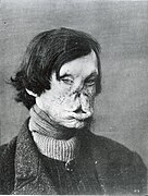 Face severely deformed by leprosy, 1985