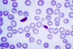 Thumbnail for Plasmodium falciparum