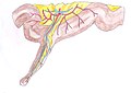 Meckel's diverticulum