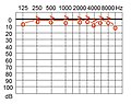 Tonaudiogramm, Normalhörigkeit