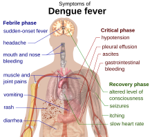 Symptoms of dengue fever