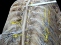 Spinal cord. Spinal membranes and nerve roots.Deep dissection. Posterior view.